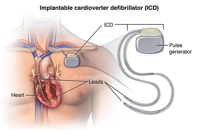 Máy khử rung tim sẽ theo dõi và điều chỉnh nhịp tim khi có dấu hiệu bất thường. (Ảnh: Health Jade)